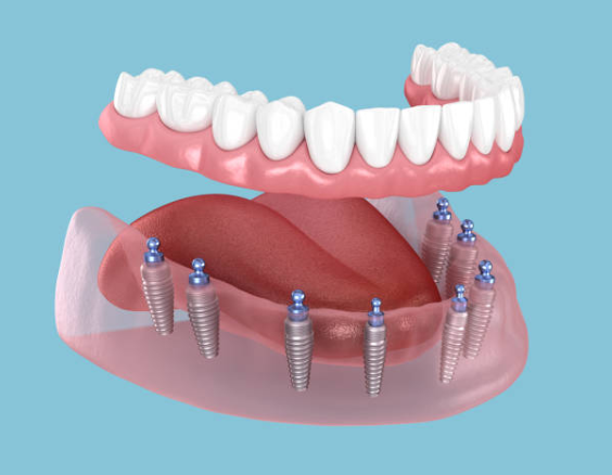 full arch dental implants New Jersey