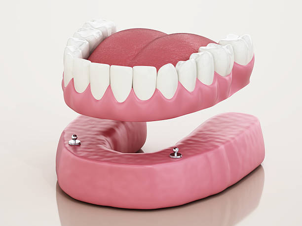 full arch dental implants caldwell