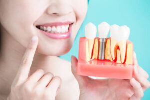 dental implants caldwell