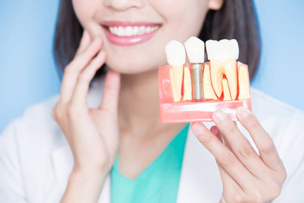 Dental Implants Guide
