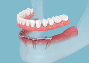 dental implants