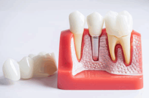 dental implants in NJ