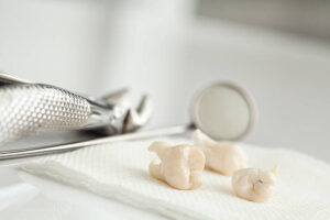 Wisdom Teeth Removal